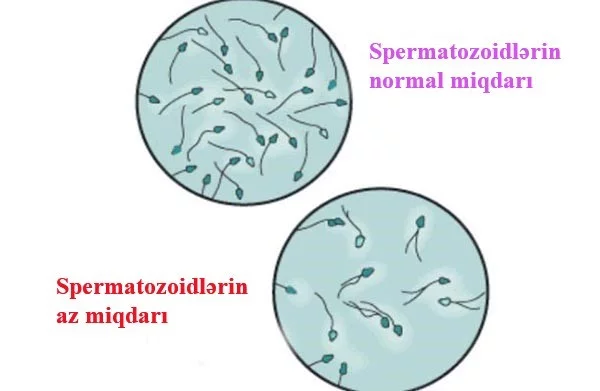 SXEM: Spermatozoidlərin azalması
