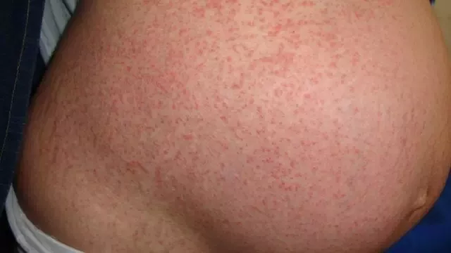 FOTO: Hamiləlikdə allergik dermatit