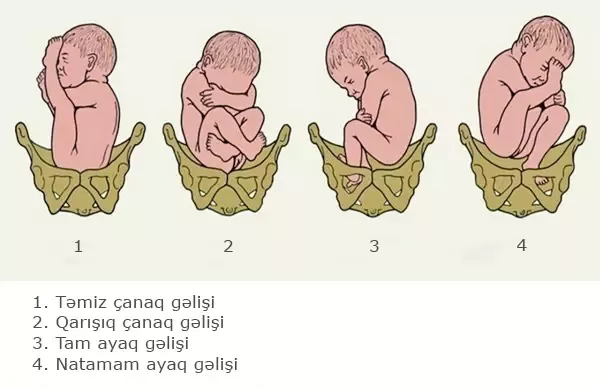 SXEM: Çanaq gəlişinin növləri