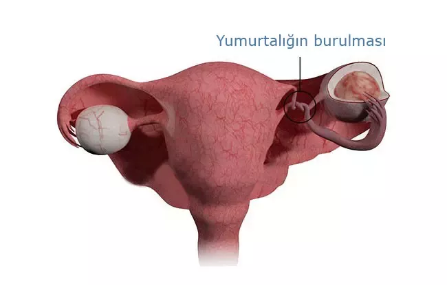 SXEM: Yumurtalığın burulması