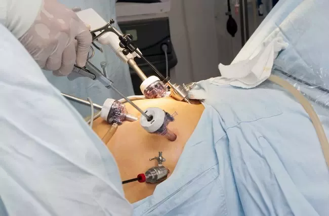 FOTO: Yumurtalıqların burulmasında ən effektiv müalicə üsulu – laparoskopik üsulla aparılan cərrahi əməliyyatdır