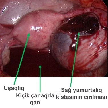 FOTO: Yumurtalıq kistasının partlaması laparoskopik üsulla əməliyyat olunur