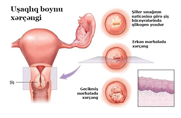 SXEM: Servikal xərçəngin formaları