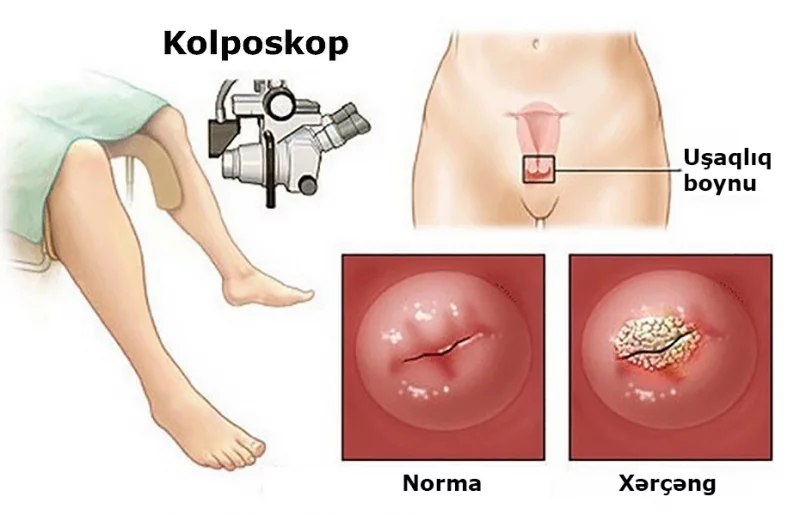 SXEM: Kolposkop uşaqlıq oynu xərçəngində əlavə diaqnostika üsuludur