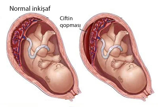 SXEM: Ciftin erkən qopması – soyulması