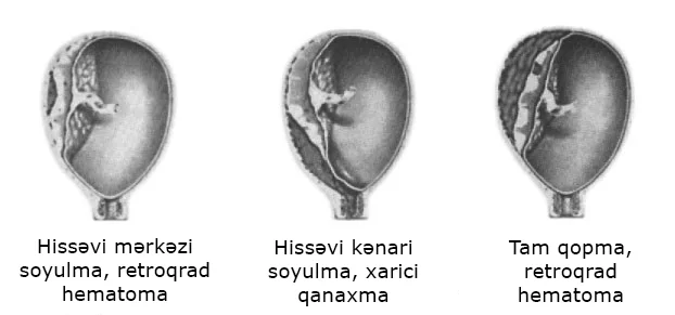 SXEM: Ciftin ayrılmasının ağırlıq dərəcələri