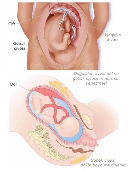 SXEM: Göbək ciyəsinin dolanması