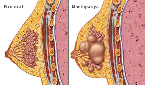 SXEM: Fibroz-kistoz mastopatiya necə olur?