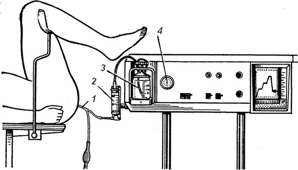 Boruların yuyulma sxemi: 1–uşaqlıq zondu; 2–dərman üçün şpris; 3–fizioloji məhlulu yığmaq üçün qab; 4–manometr