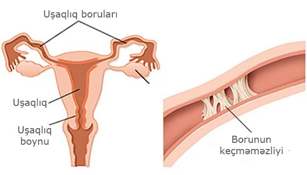 SXEM: Uşaqlıq borularının yuyulması boru keçməməzliyinin əsas müalicə üsullarından biridir