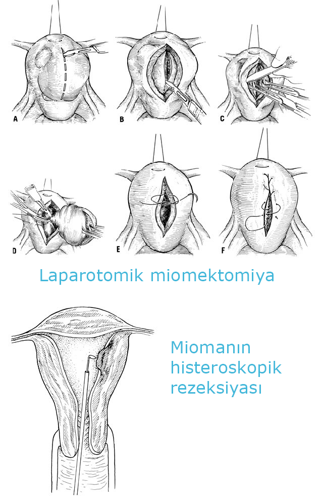 SXEM: Miomektomiyanın üsulları