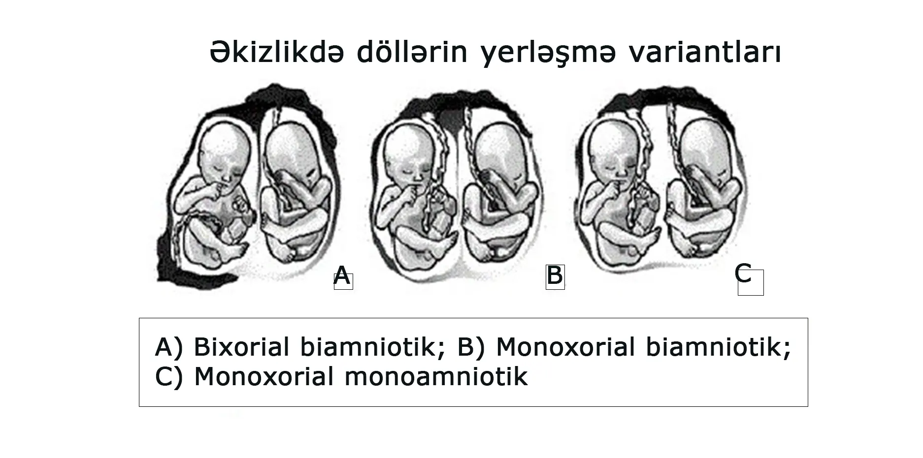 SXEM: Əkiz döllərin yerləşmə variantları