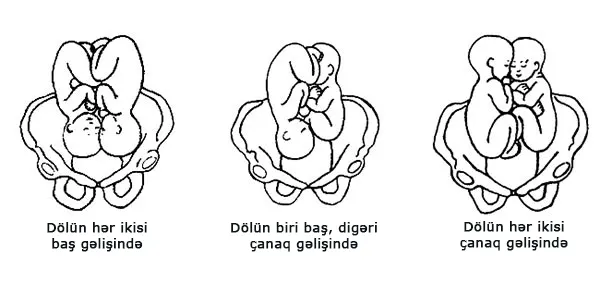 SXEM: Əkiz döllərin gəliş variantları