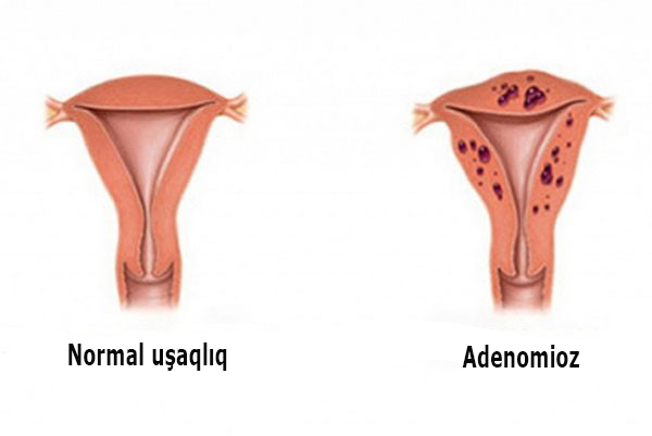 SXEM: Adenomiozlu uşaqlıq