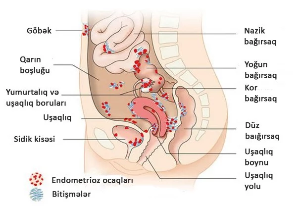 Endometriozun növləri