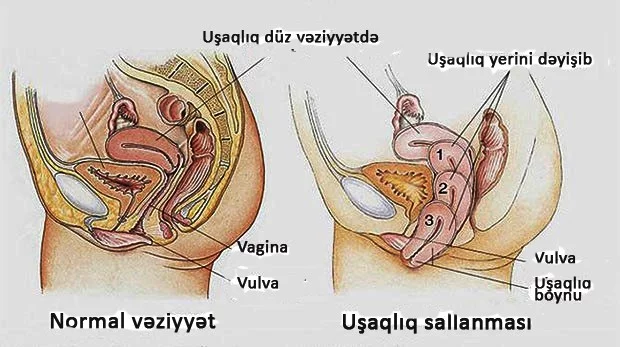 FOTO: Uşaqlıq sallanmasının mexanizmi