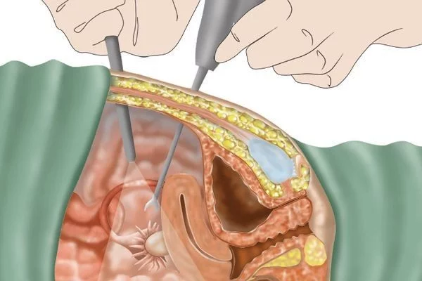 Laparoskopik endometrial kistektomiya