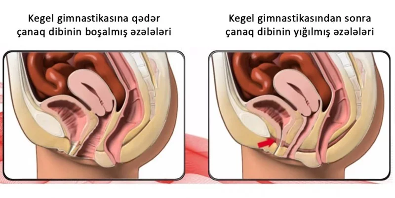 Kegel gimnastikasının təsiri