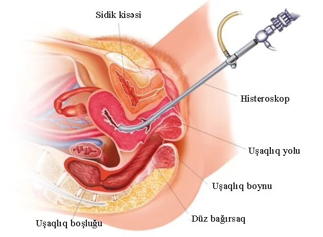 Uşaqlıqdaxili bitişmələrdə histeroskopiya