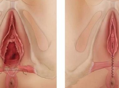 vaginoplastika vaginanın daraldılması