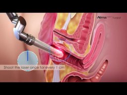 Alma Lasers aparatı ilə vaginal cavanlaşma